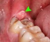 Đau nhức răng, sâu răng ê buốt, viêm nướu, răng lung lay sẽ khỏi sau 1 ngày nhờ ngậm thứ này trong 10 phút